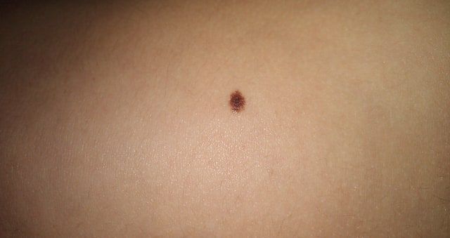 Common mole
