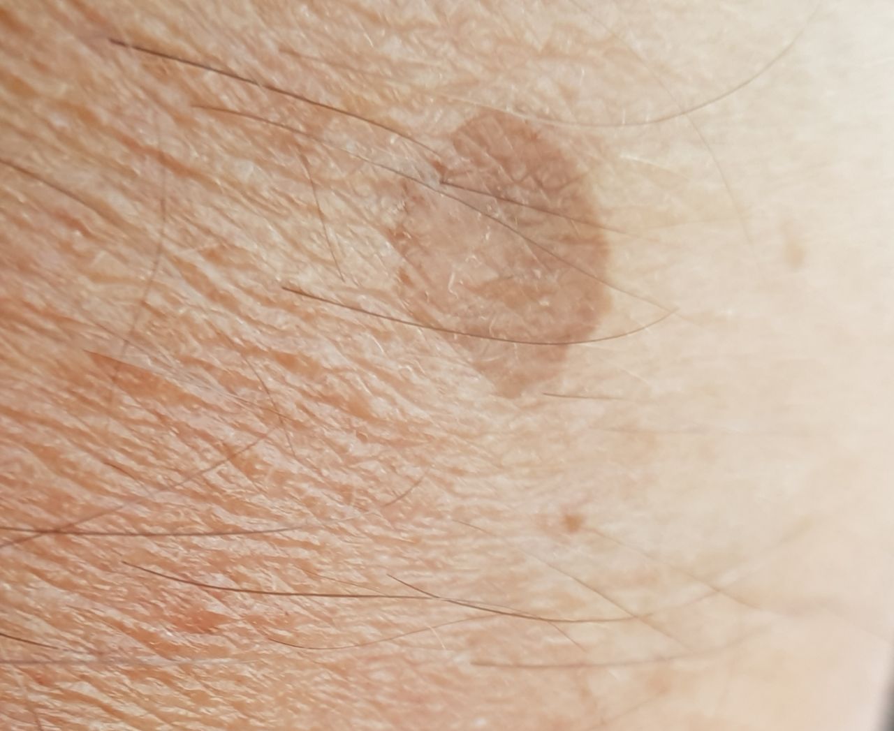 actinic lentigo