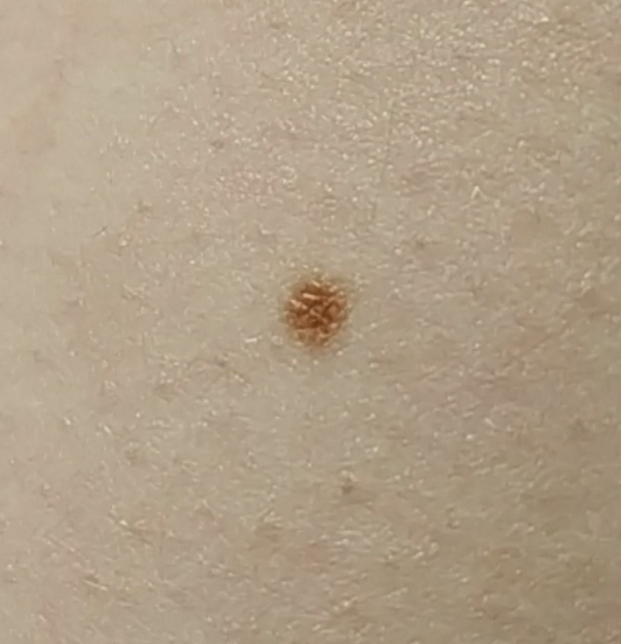 Benign mole