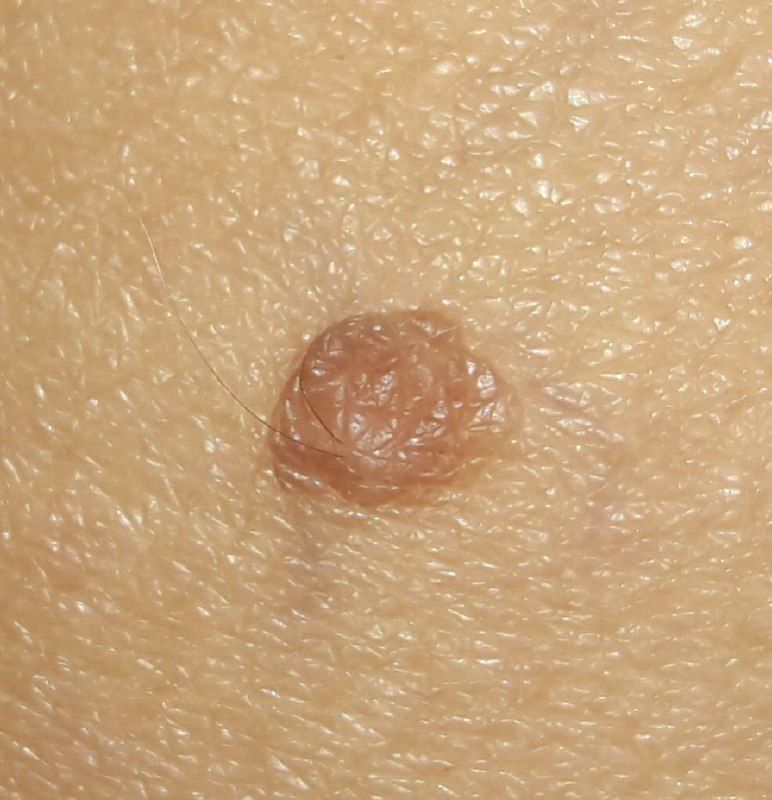 Papillomatous nevus