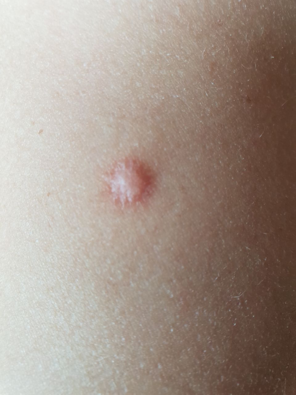 Benign fibrous histiocytoma