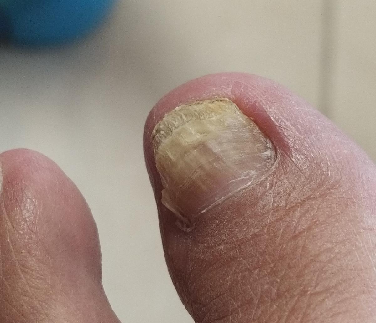 onychomycosis