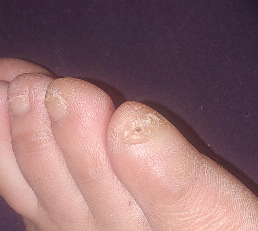 Nail fungus