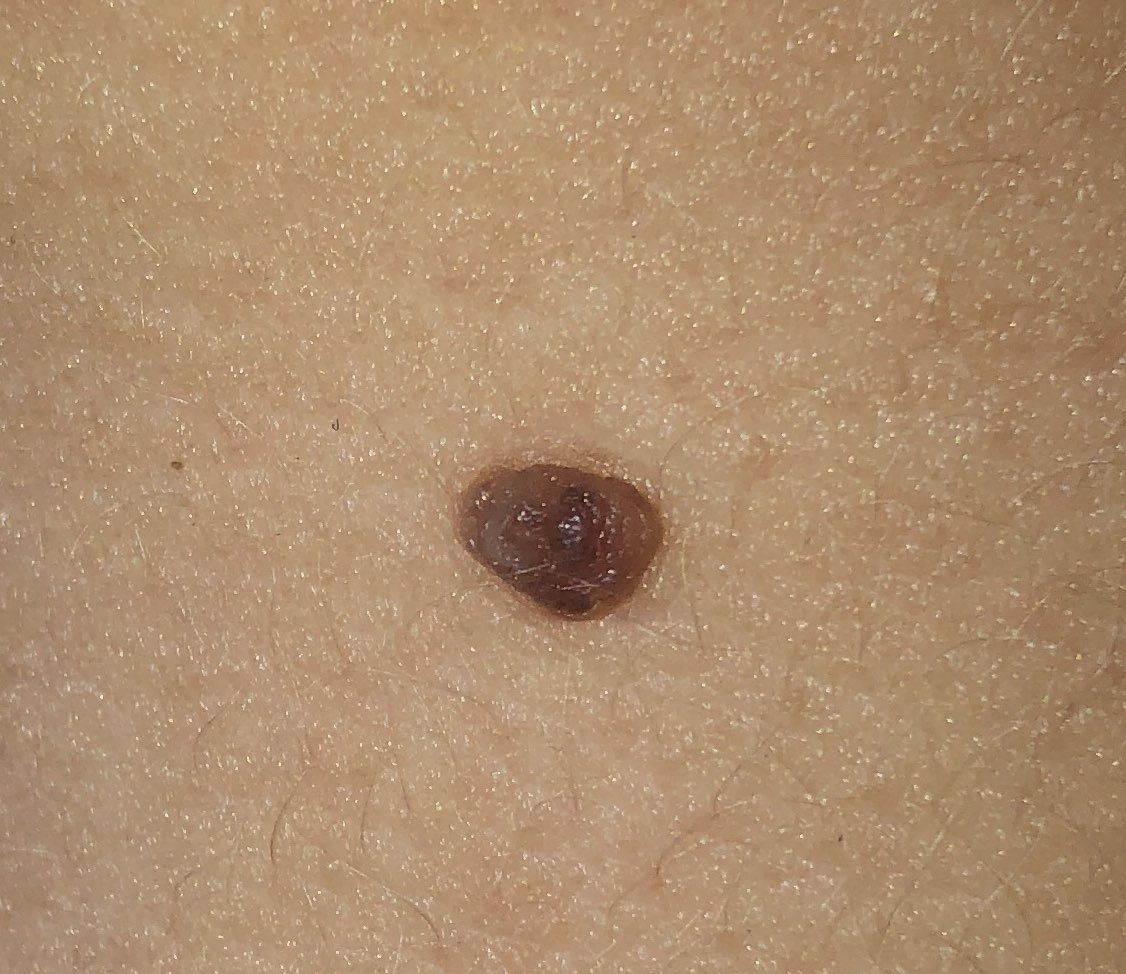 Papillomatous nevus