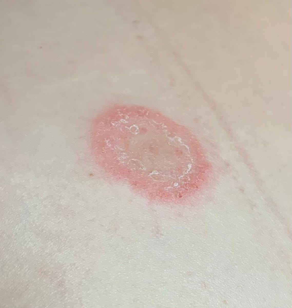 skin fungus