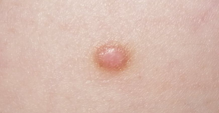 Skin fibroma