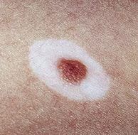 Halo Nevus
