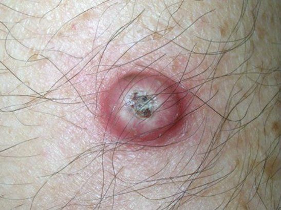 Keratoacanthoma