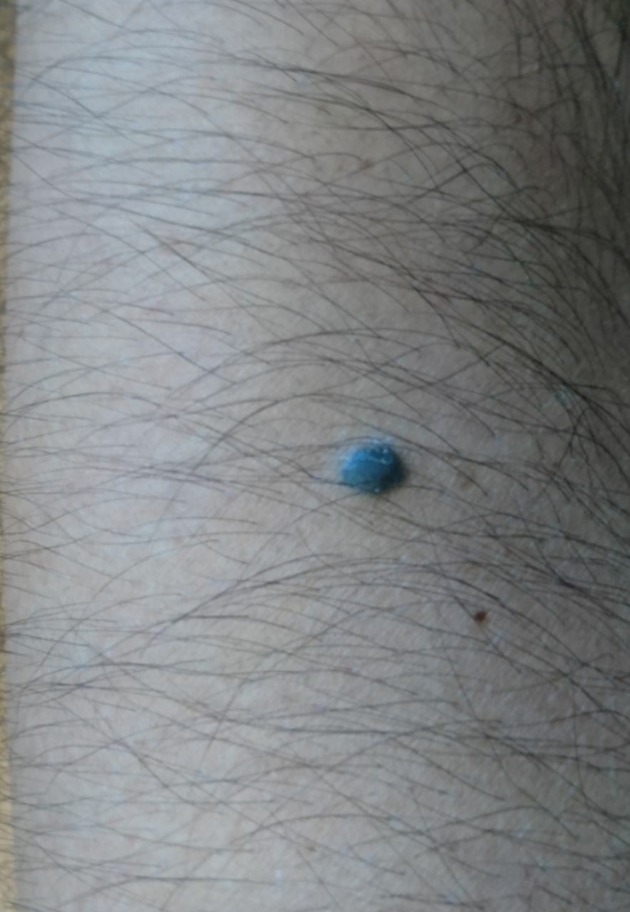 Blue nevus