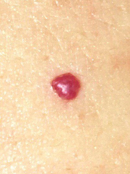 Red skin spot