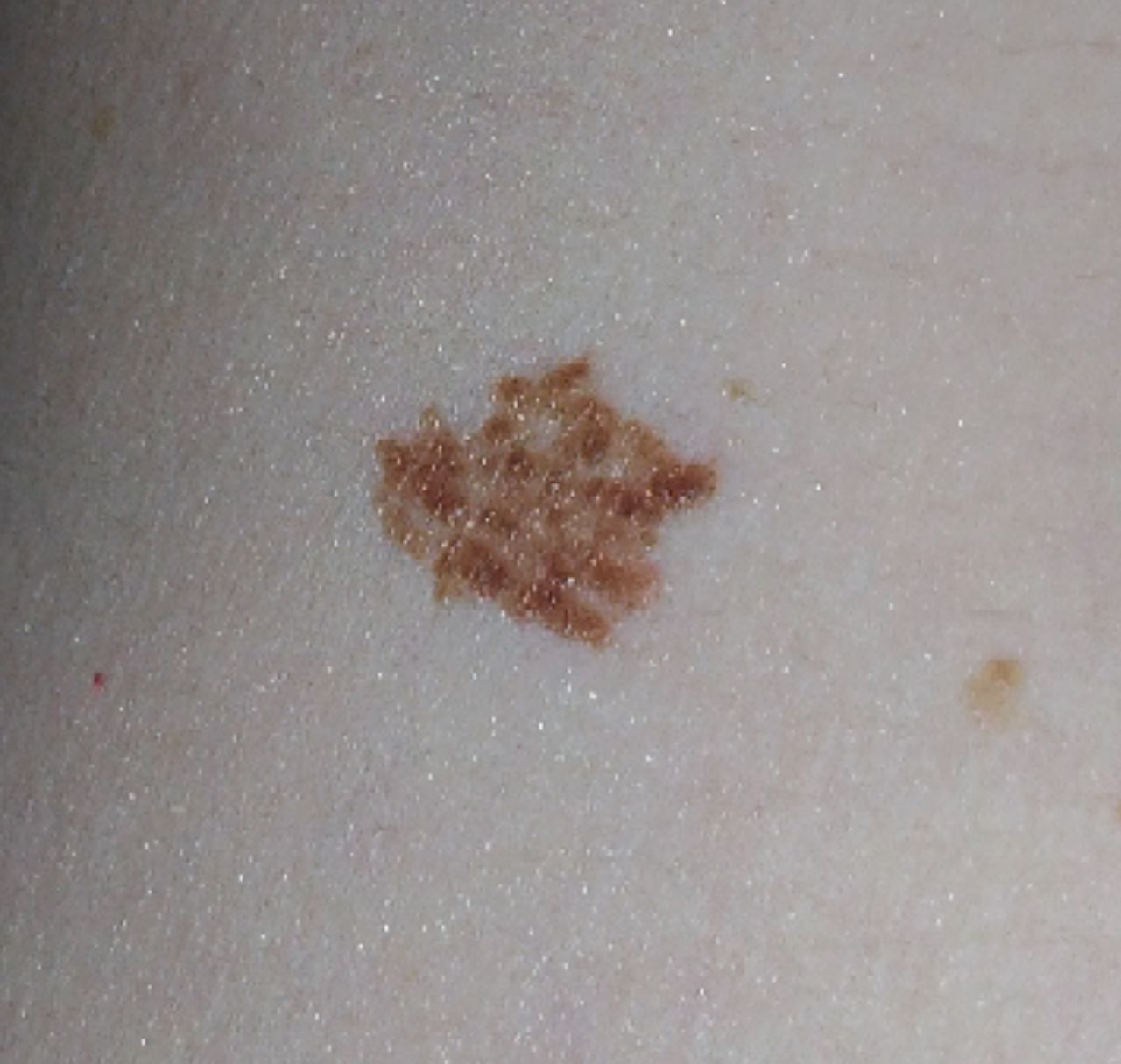 atypical mole