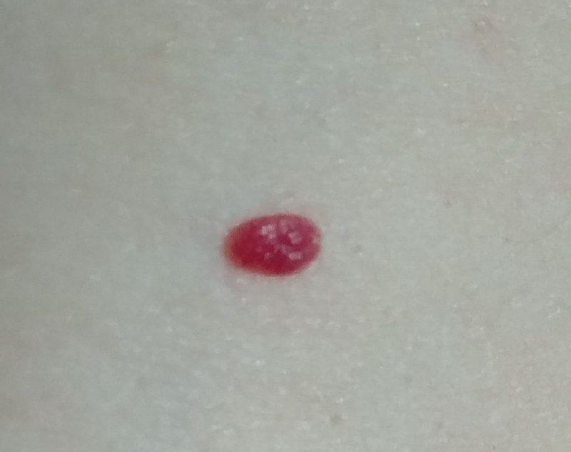 Hemangioma