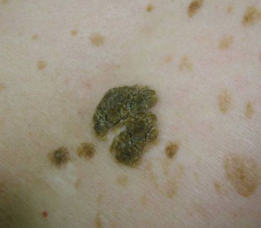 seborrheic wart