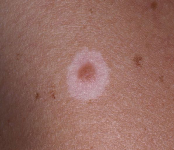 Sutton Nevus