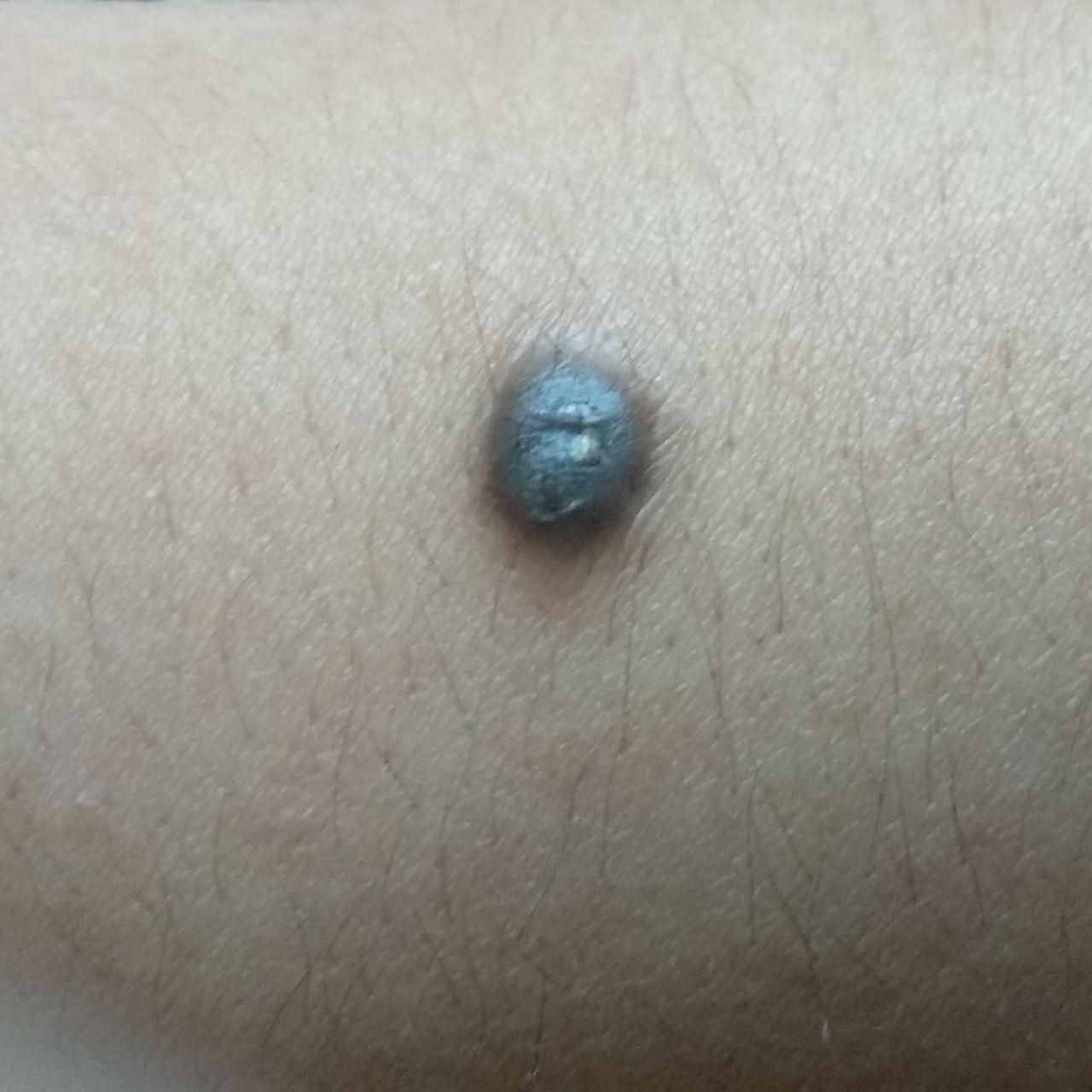 Blue nevus