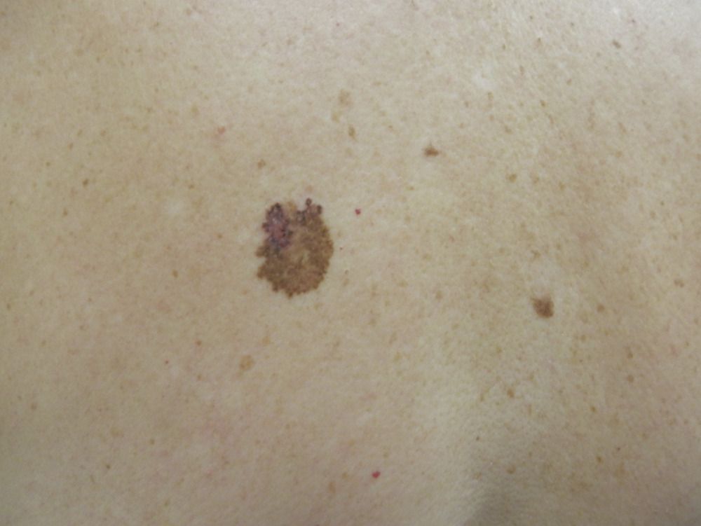 Lentigo Melanoma