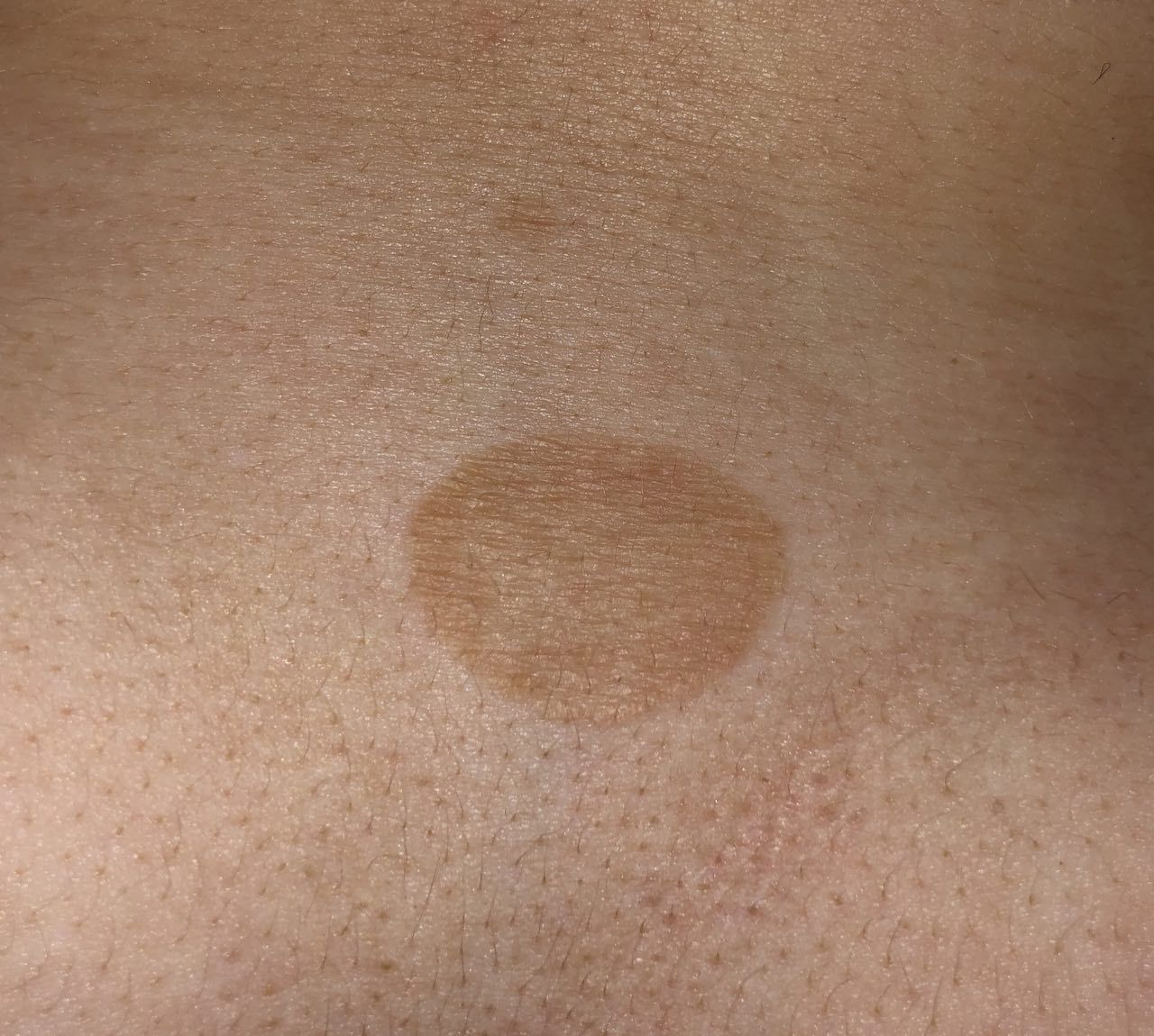 melanin hyperpigmentation