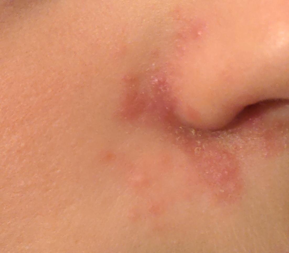 Seborrheic dermatitis