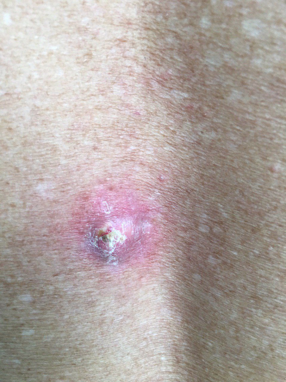 Squamous cell carcinoma