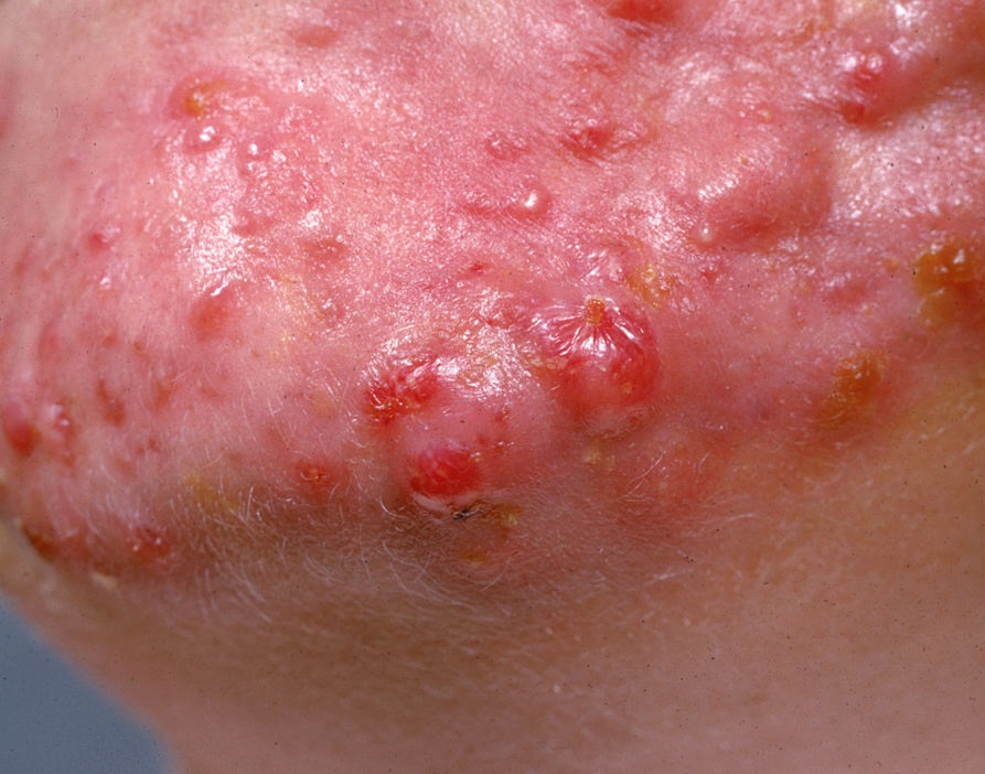 cysts