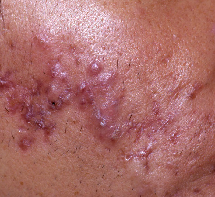 papules