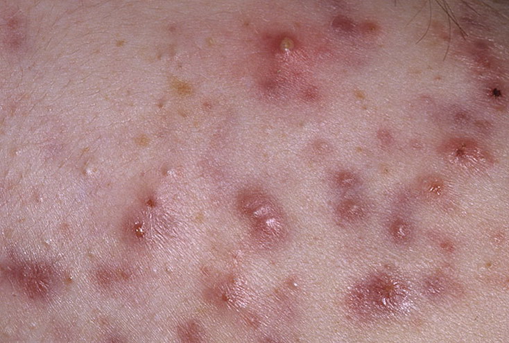 acne cystic