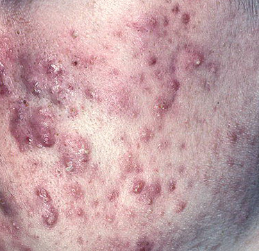 nodules
