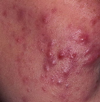 acne cystic