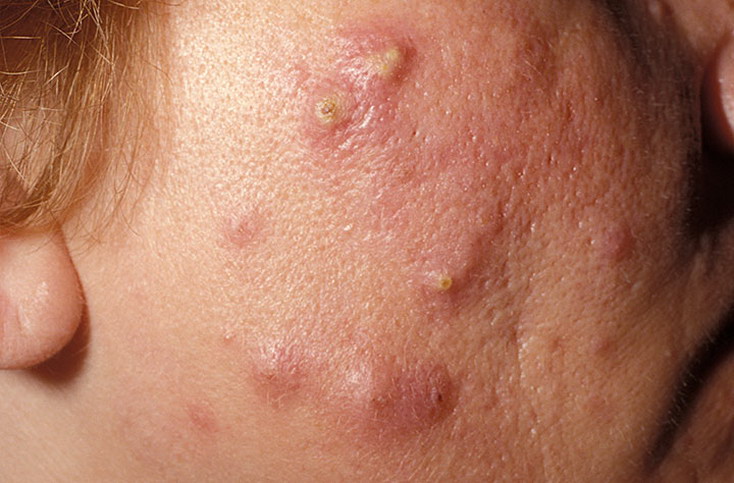 acne cystic