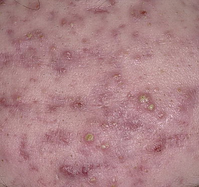 acne cystic