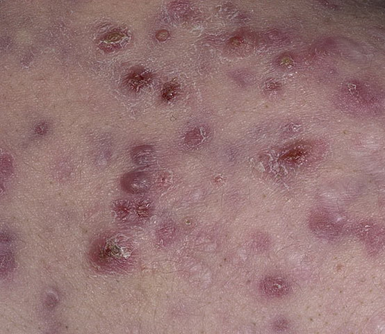 acne cystic