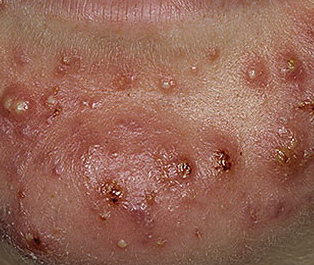 acne cystic