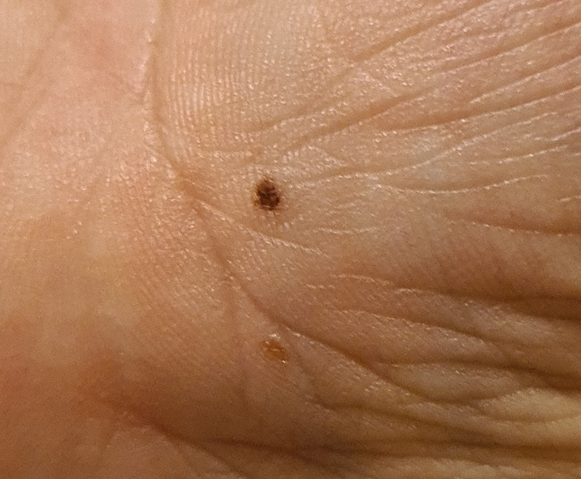 Acral mole