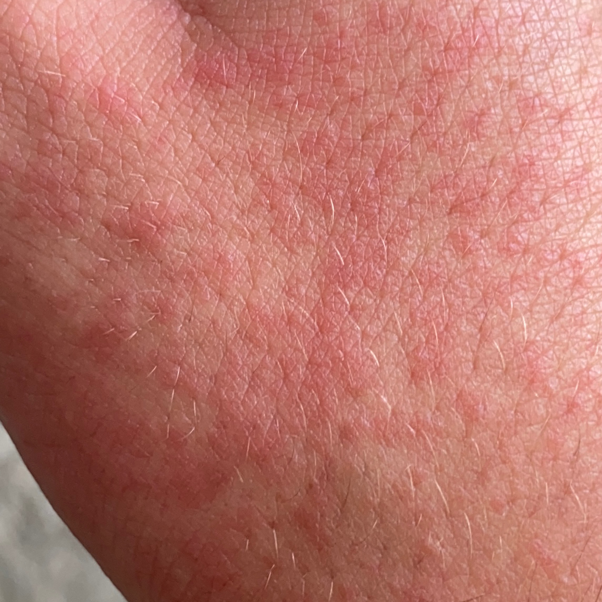 Skin inflamination
