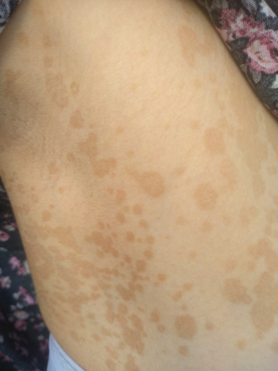 Variegated lichen planus