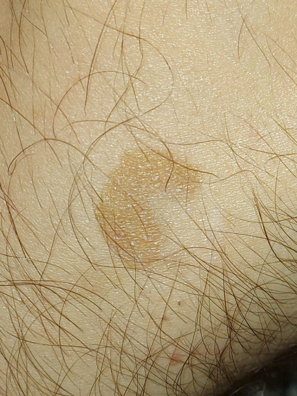 papillary lichen planus