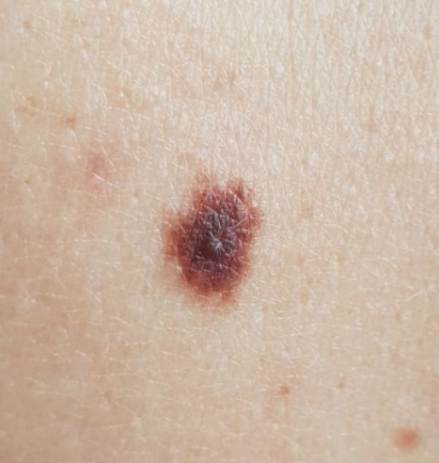 nevus